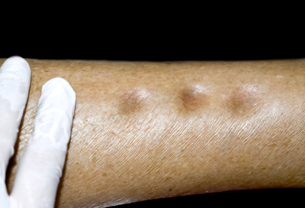 A thumb pressed into the shin above the ankle to test for a lasting dent